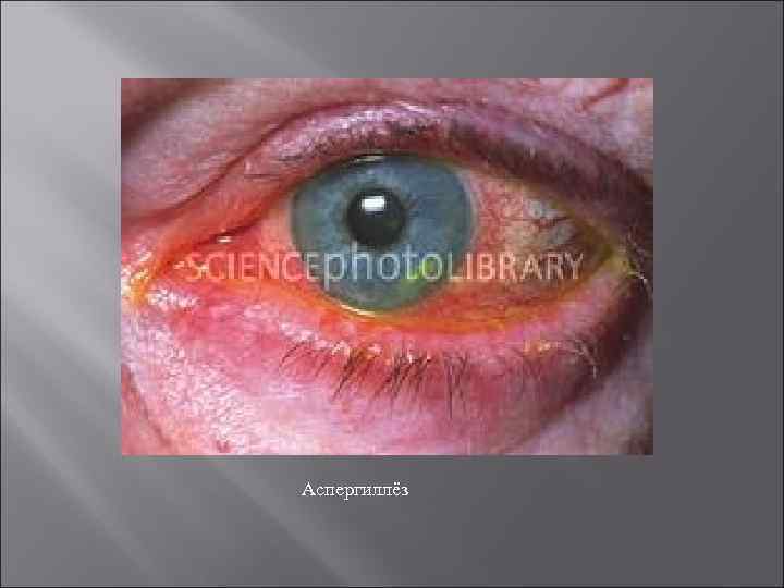 Аспергиллёз 