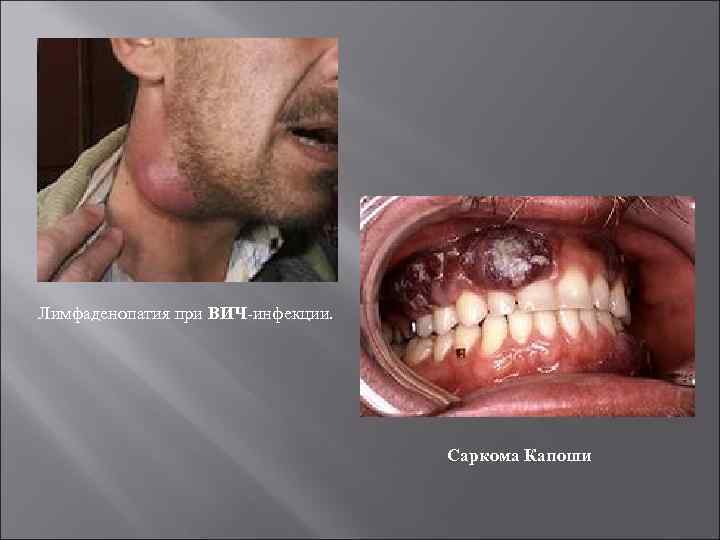 Лимфаденопатия при ВИЧ-инфекции. Саркома Капоши 