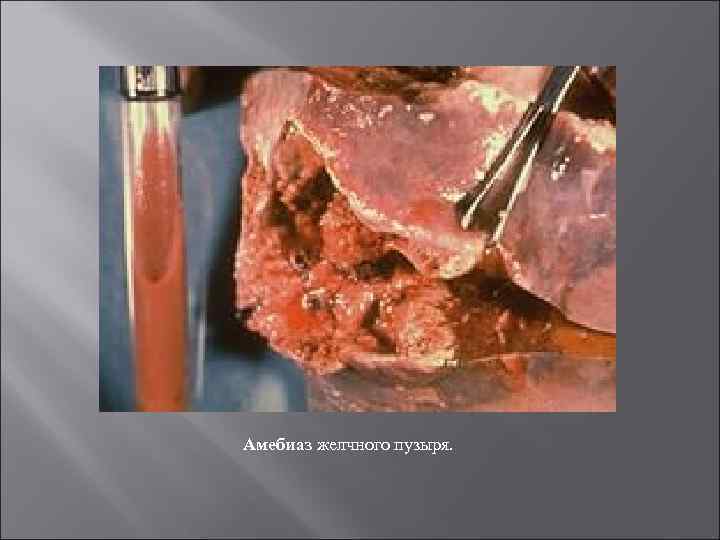 Амебиаз желчного пузыря. 