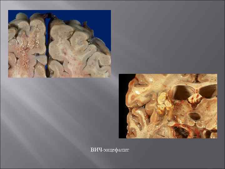 ВИЧ-энцефалит 