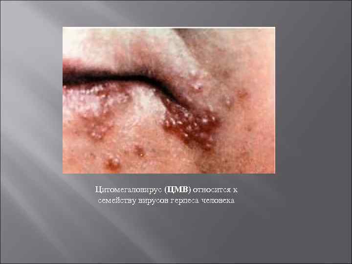 Цитомегаловирус (ЦМВ) относится к семейству вирусов герпеса человека 