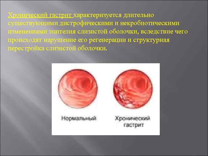 Хронический гастрит характеризуется длительно существующими дистрофическими и некробиотическими изменениями эпителия слизистой оболочки, вследствие чего