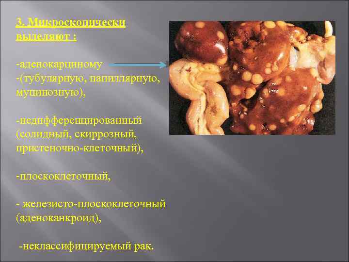 3. Микроскопически выделяют : -аденокарциному -(тубулярную, папиллярную, муцинозную), -недифференцированный (солидный, скиррозный, пристеночно-клеточный), -плоскоклеточный, -