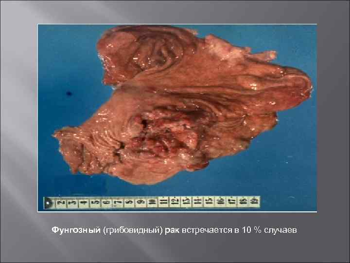 Фунгозный (грибовидный) рак встречается в 10 % случаев 