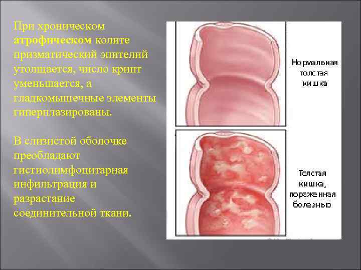 При хроническом атрофическом колите призматический эпителий утолщается, число крипт уменьшается, а гладкомышечные элементы гиперплазированы.