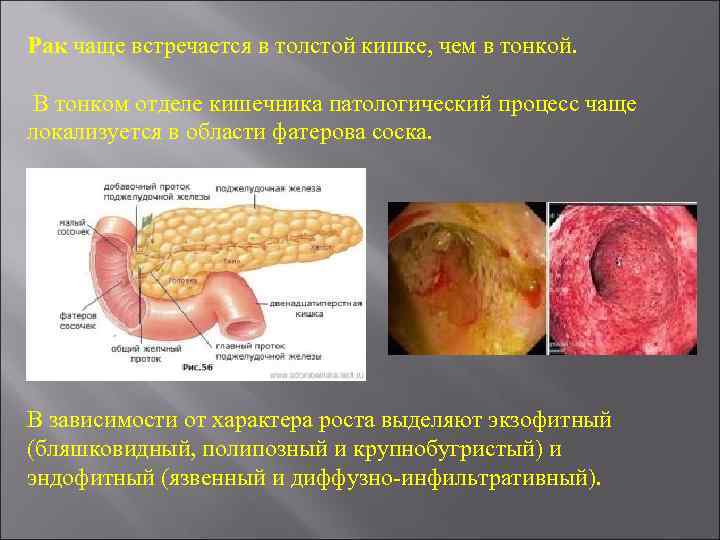 Рак чаще встречается в толстой кишке, чем в тонкой. В тонком отделе кишечника патологический