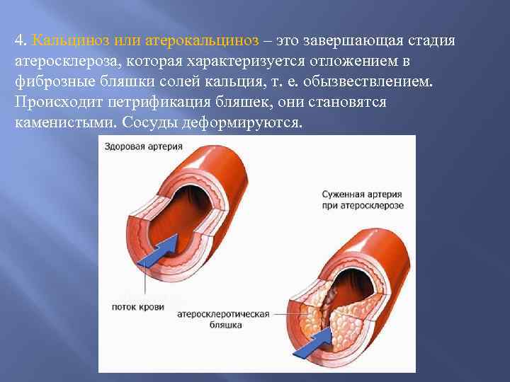 Кальциноз сосудов лечение