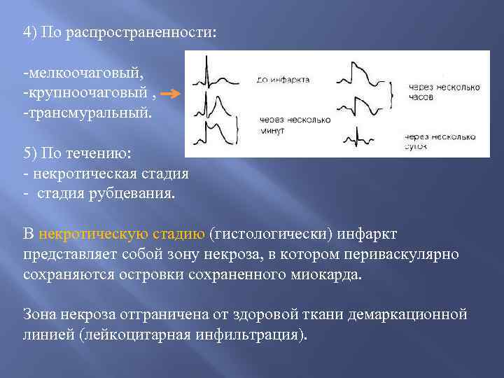 Чем отличается инфаркт. Трансмуральный крупноочаговый мелкоочаговый. Крупноочаговый и мелкоочаговый инфаркт миокарда. Крупноочаговый трансмуральный инфаркт миокарда. Крупноочаговый инфаркт миокарда подострая стадия.