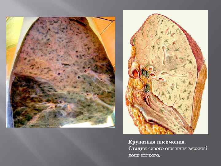 Крупозная пневмония. Стадия серого опечения верхней доли легкого. 