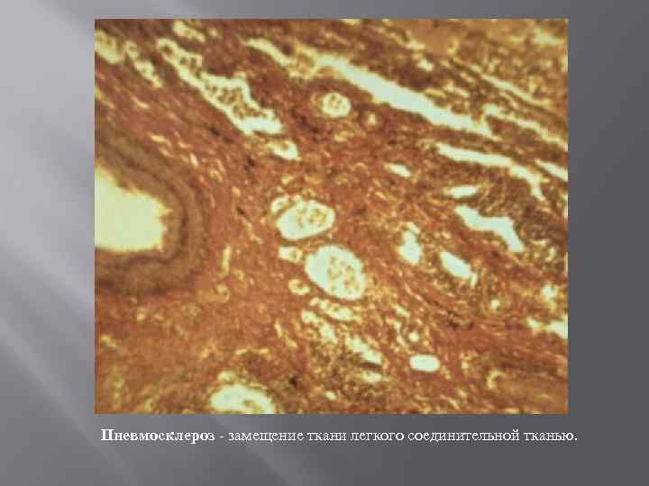 Пневмосклероз - замещение ткани легкого соединительной тканью. 