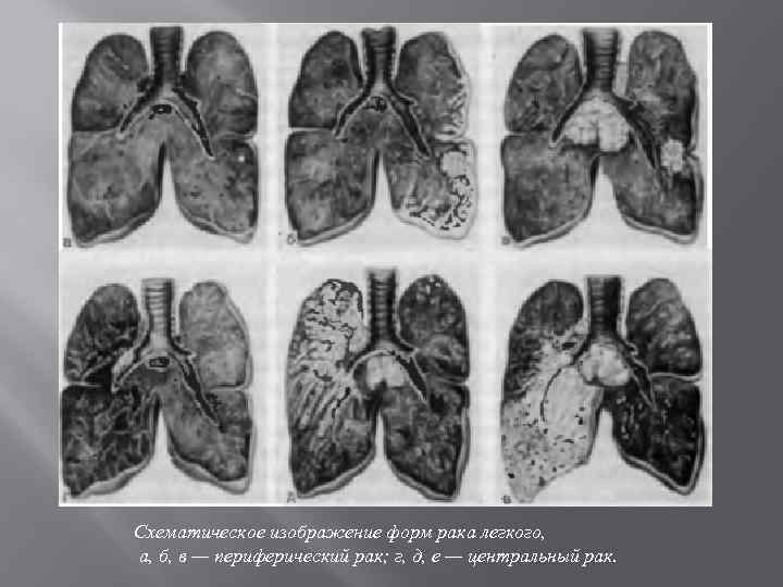 Схематическое изображение форм рака легкого, а, б, в — периферический рак; г, д, е