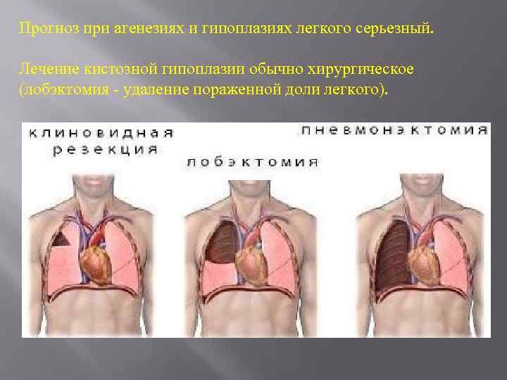 Прогноз при агенезиях и гипоплазиях легкого серьезный. Лечение кистозной гипоплазии обычно хирургическое (лобэктомия -