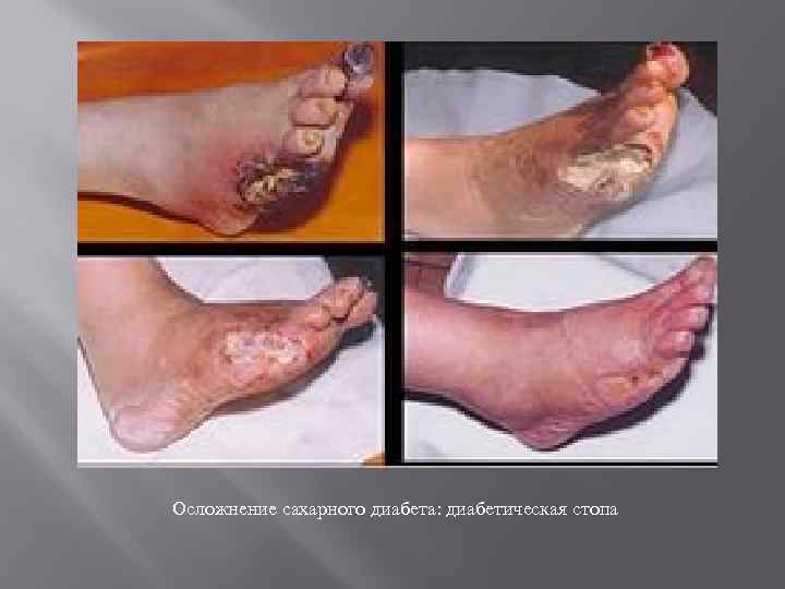 Осложнение сахарного диабета: диабетическая стопа 