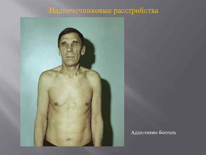 Надпочечниковые расстройства Аддисонова болезнь 
