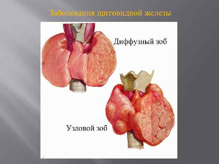 Заболевания щитовидной железы 