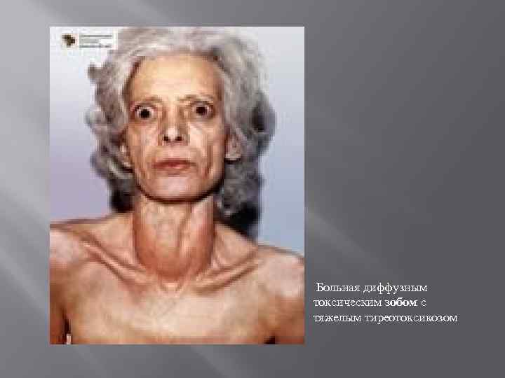  Больная диффузным токсическим зобом с тяжелым тиреотоксикозом 