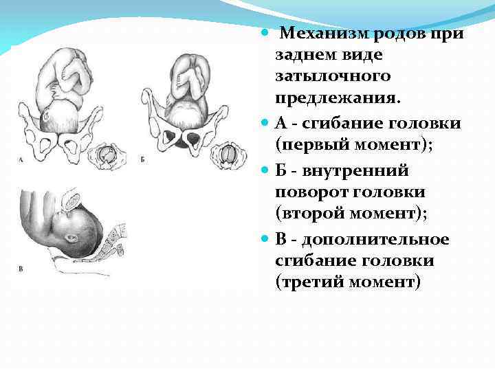 Родоразрешение при предлежании. Задний вид затылочного предлежания биомеханизм родов. Механизм родов при переднем виде головного предлежания. Передний вид головного предлежания биомеханизм родов. Биомеханизм родов при заднем виде затылочного предлежания плода.