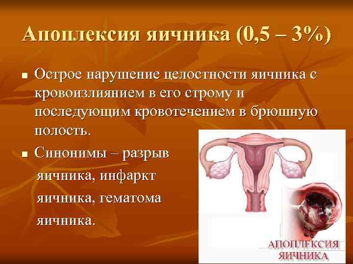 Апоплексия яичника (0, 5 – 3%) Острое нарушение целостности яичника с кровоизлиянием в его