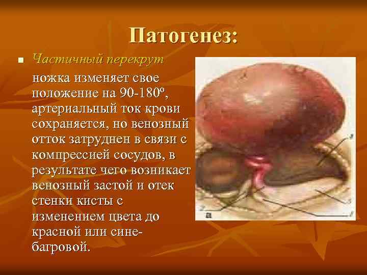 Патогенез: Частичный перекрут ножка изменяет свое положение на 90 -180º, артериальный ток крови сохраняется,