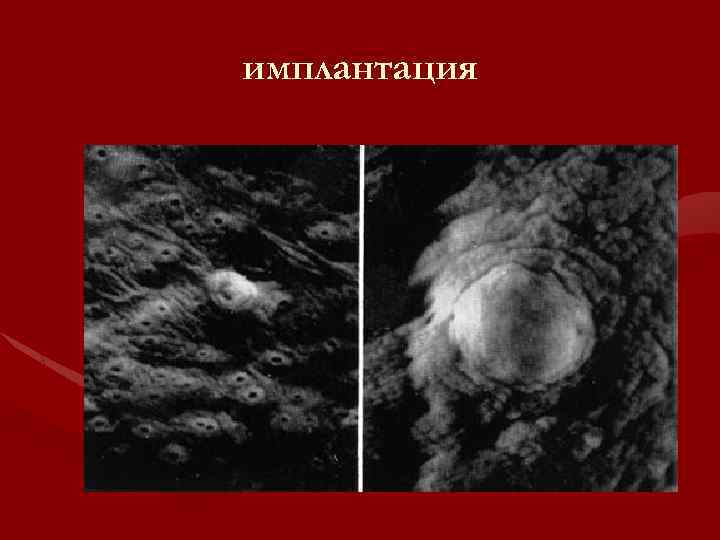 имплантация 