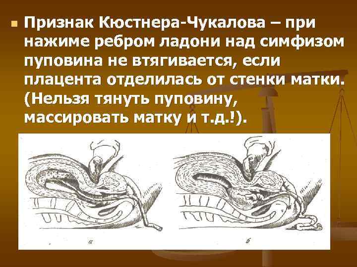 n Признак Кюстнера-Чукалова – при нажиме ребром ладони над симфизом пуповина не втягивается, если