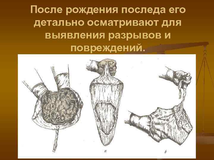 После рождения последа его детально осматривают для выявления разрывов и повреждений. 