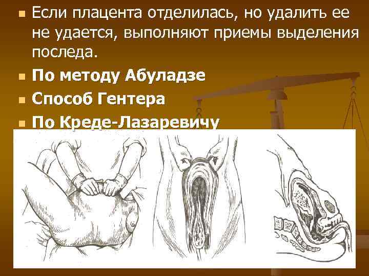 n n Если плацента отделилась, но удалить ее не удается, выполняют приемы выделения последа.