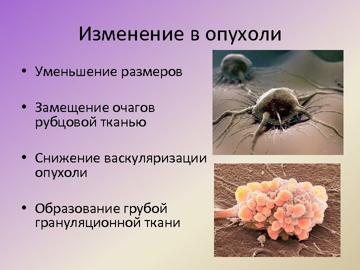 Изменение в опухоли • Уменьшение размеров • Замещение очагов рубцовой тканью • Снижение васкуляризации