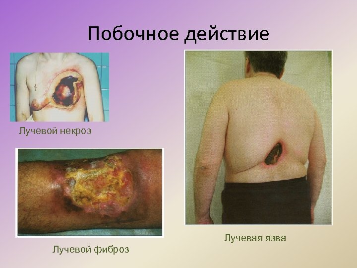 Побочное действие Лучевой некроз Лучевая язва Лучевой фиброз 