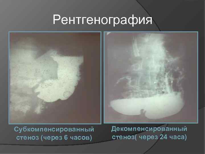 Рентгенография Субкомпенсированный стеноз (через 6 часов) Декомпенсированный стеноз( через 24 часа) 