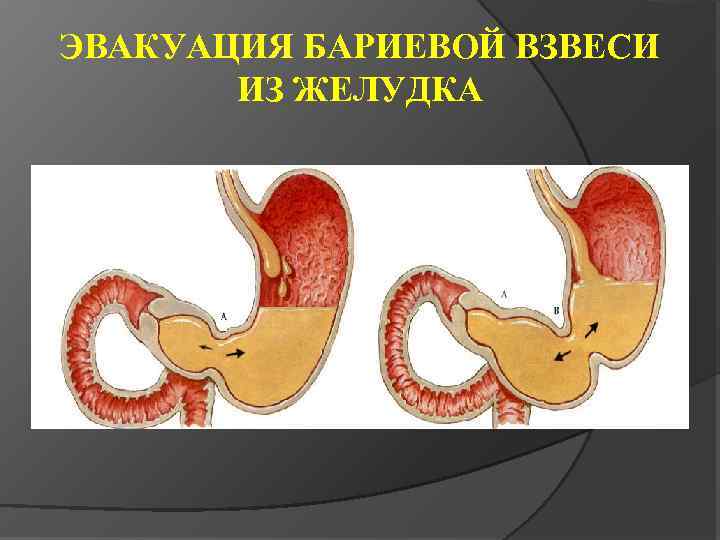 ЭВАКУАЦИЯ БАРИЕВОЙ ВЗВЕСИ ИЗ ЖЕЛУДКА 