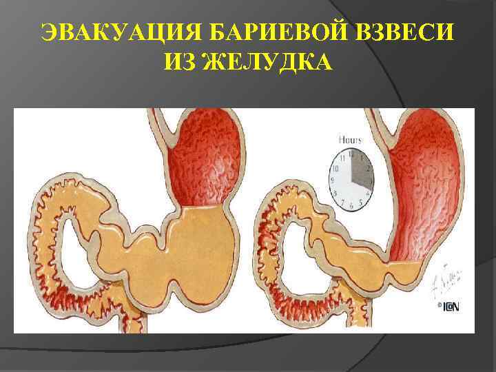 ЭВАКУАЦИЯ БАРИЕВОЙ ВЗВЕСИ ИЗ ЖЕЛУДКА 