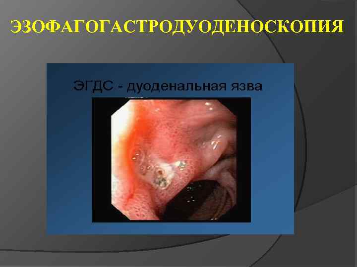 ЭЗОФАГОГАСТРОДУОДЕНОСКОПИЯ 
