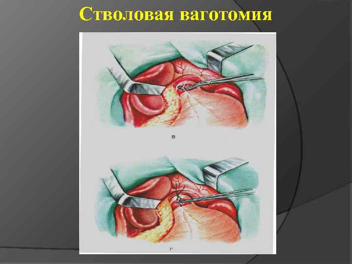 Стволовая ваготомия 