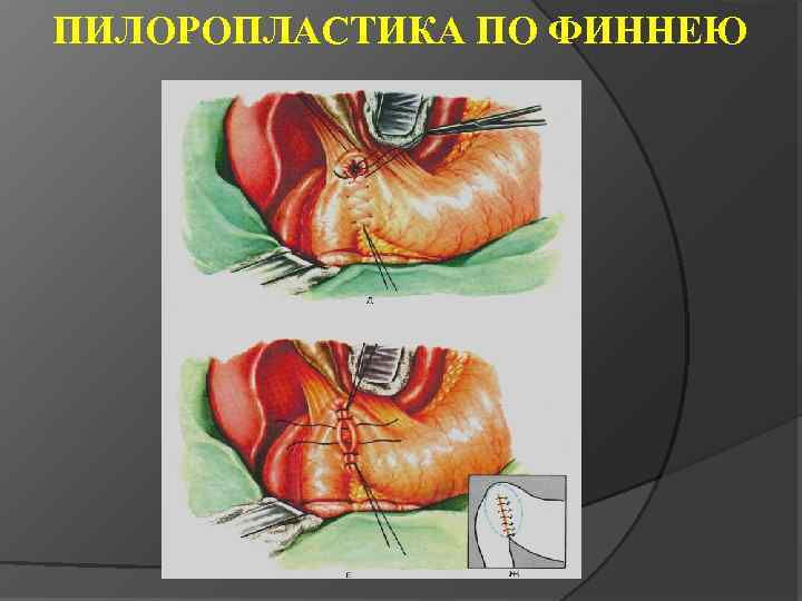 ПИЛОРОПЛАСТИКА ПО ФИННЕЮ 