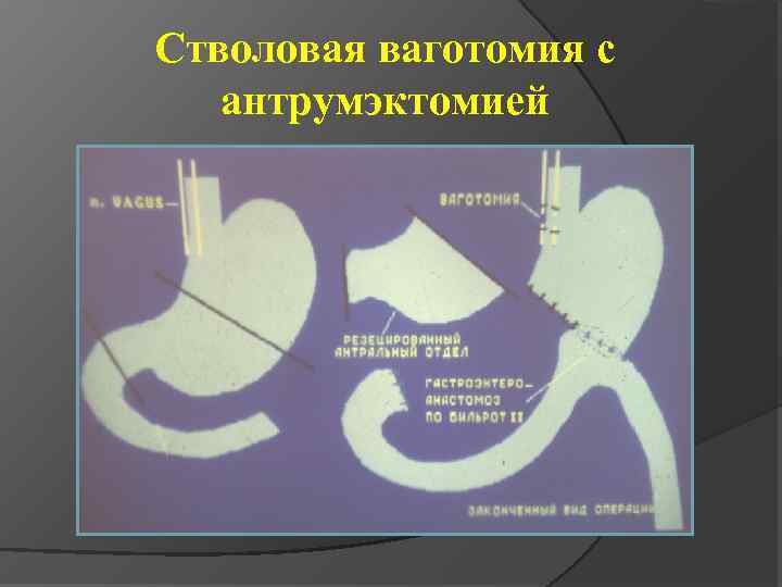 Стволовая ваготомия с антрумэктомией 
