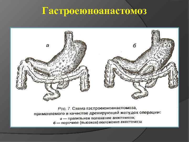 Анастомоз по ру схема