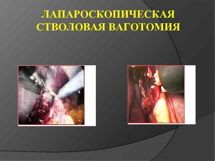 ЛАПАРОСКОПИЧЕСКАЯ СТВОЛОВАЯ ВАГОТОМИЯ 