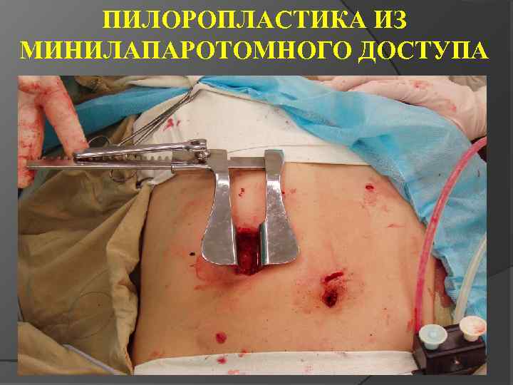 ПИЛОРОПЛАСТИКА ИЗ МИНИЛАПАРОТОМНОГО ДОСТУПА 