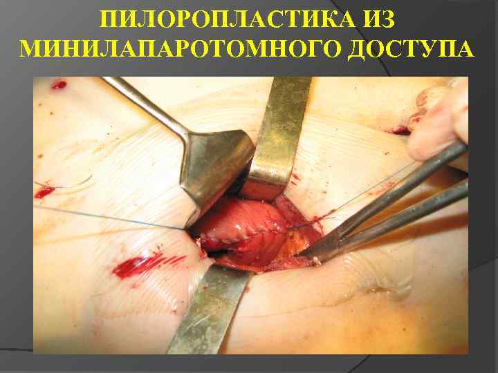 ПИЛОРОПЛАСТИКА ИЗ МИНИЛАПАРОТОМНОГО ДОСТУПА 