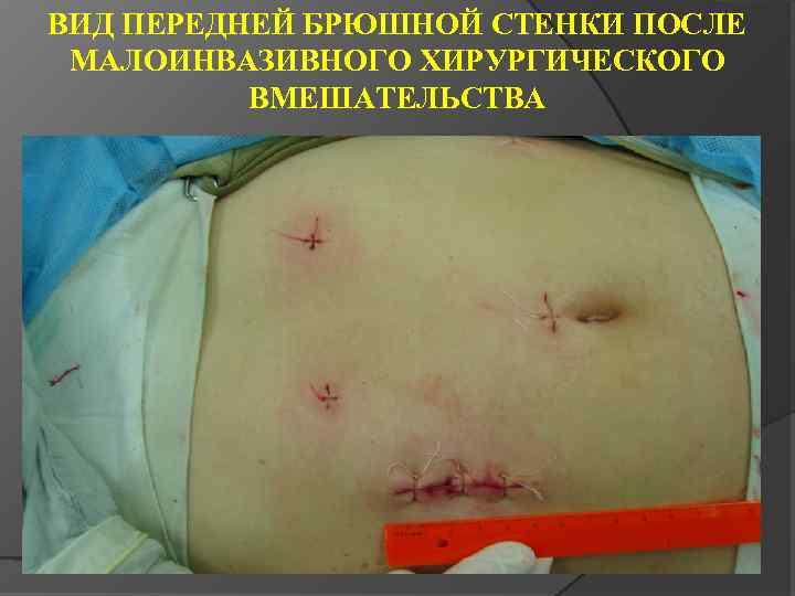 ВИД ПЕРЕДНЕЙ БРЮШНОЙ СТЕНКИ ПОСЛЕ МАЛОИНВАЗИВНОГО ХИРУРГИЧЕСКОГО ВМЕШАТЕЛЬСТВА 