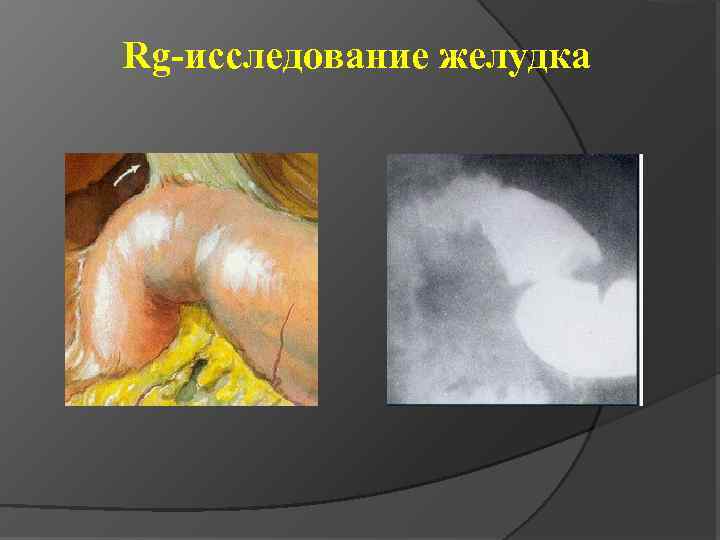 Rg-исследование желудка 