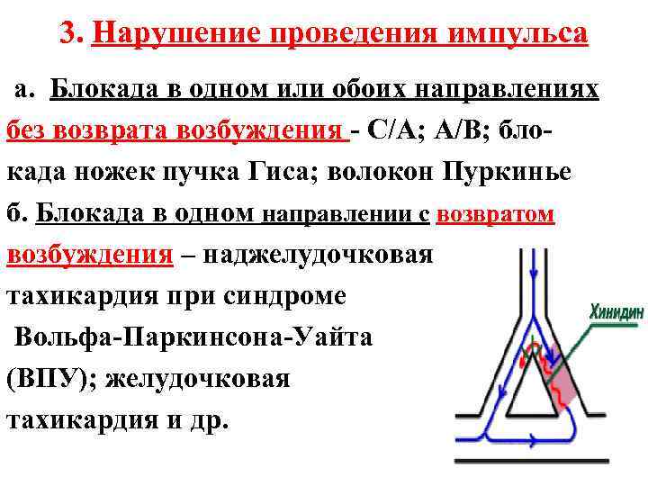 3. Нарушение проведения импульса а. Блокада в одном или обоих направлениях без возврата возбуждения