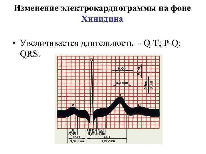 Изменение электрокардиограммы на фоне Хинидина • Увеличивается длительность - Q-T; P-Q; QRS. 