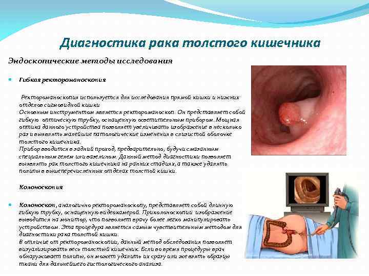 Диагностика рака толстого кишечника Эндоскопические методы исследования Гибкая ректороманоскопия Ректороманоскопия используется для исследования прямой