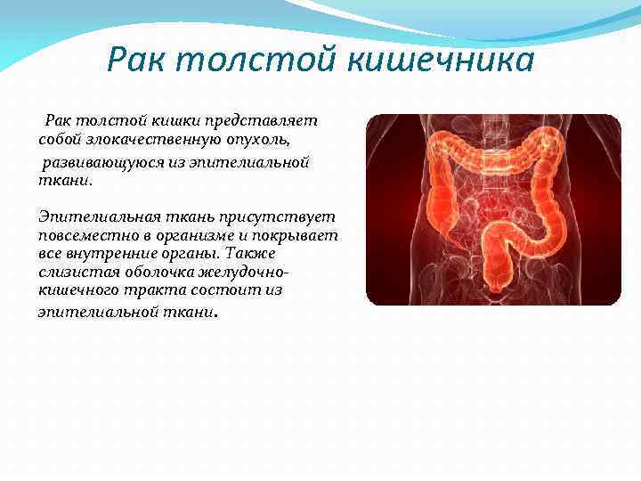 Рак толстой кишечника Рак толстой кишки представляет собой злокачественную опухоль, развивающуюся из эпителиальной ткани.