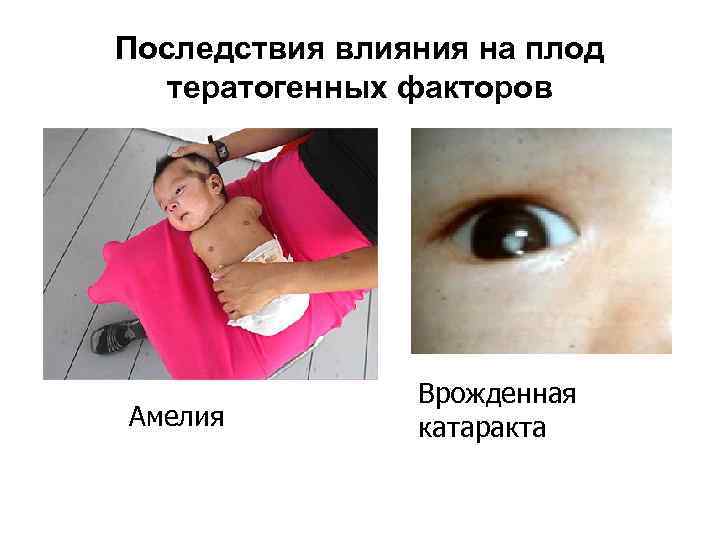Последствия влияния на плод тератогенных факторов Амелия Врожденная катаракта 