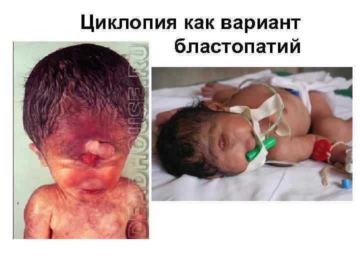 Циклопия как вариант бластопатий 