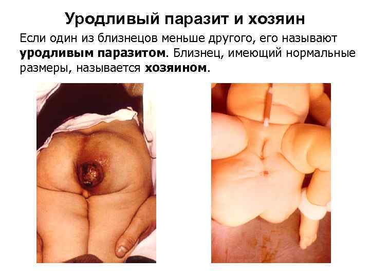Уродливый паразит и хозяин Если один из близнецов меньше другого, его называют уродливым паразитом.