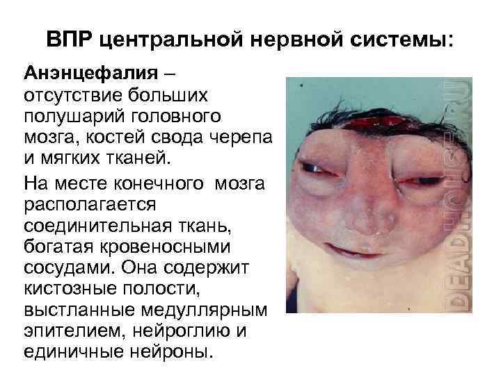 ВПР центральной нервной системы: Анэнцефалия – отсутствие больших полушарий головного мозга, костей свода черепа